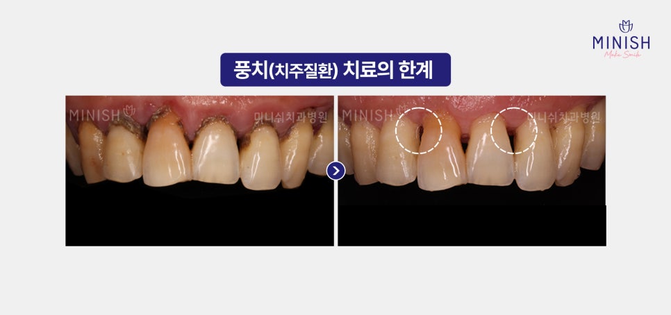 풍치치료 한계 잇몸내려앉음 핑크미니쉬로 해결! 관련 이미지 6