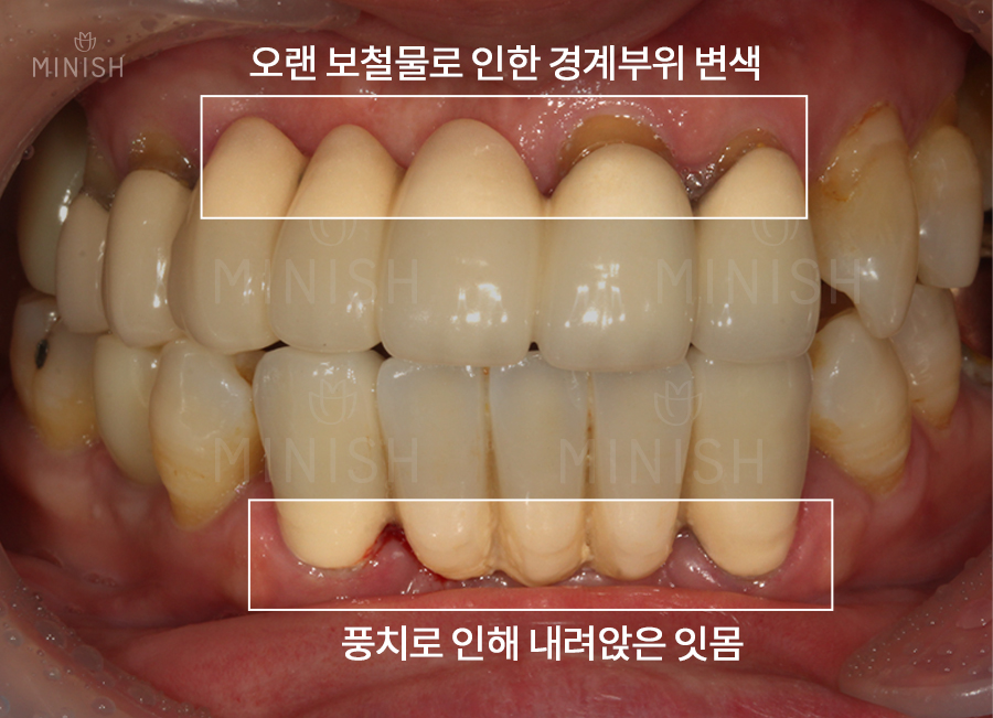 잘못된 크라운! 재치료하다 | 강남구청치과 관련 이미지 3