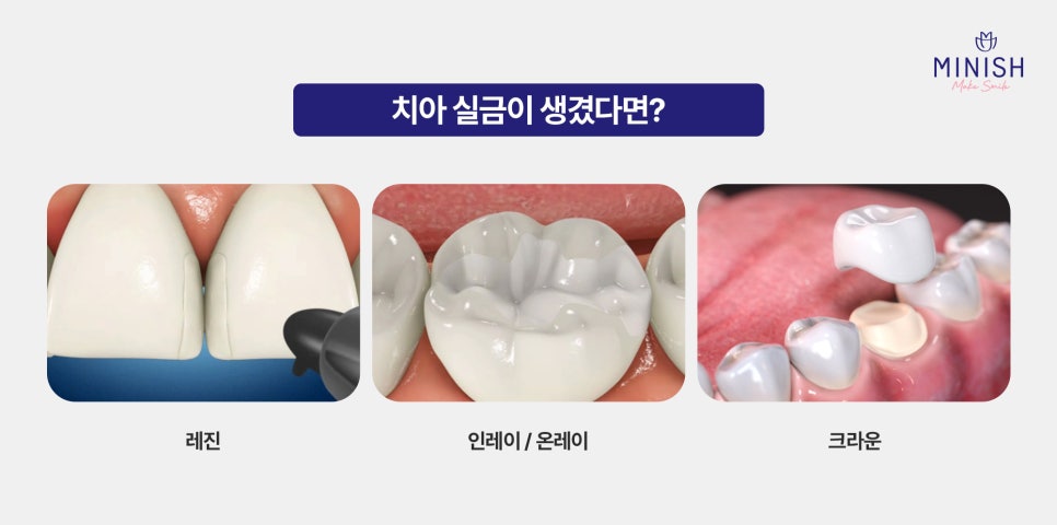 Have a Tooth Crack? You Shouldn’t Ignore It! From Causes to Improvement Methods image 4