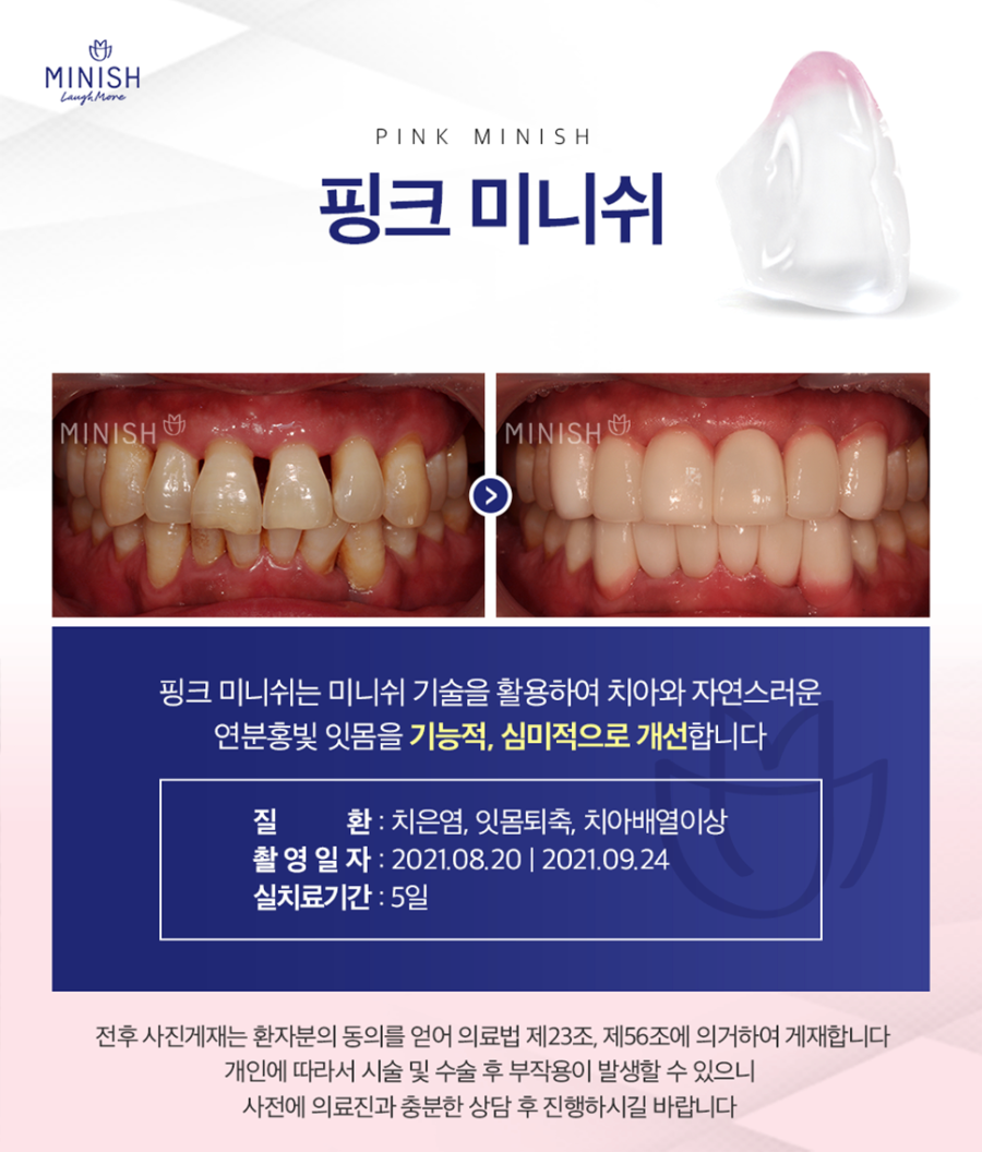 압구정로데오치과 치아와 잇몸을 모두 개선하는 방법 관련 이미지 4