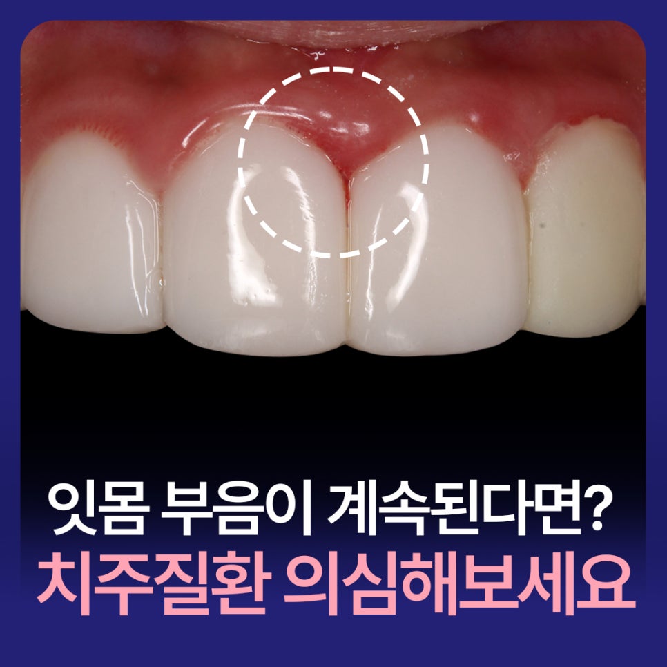 If Gum Swelling Continues, Suspect Periodontal Disease image 1