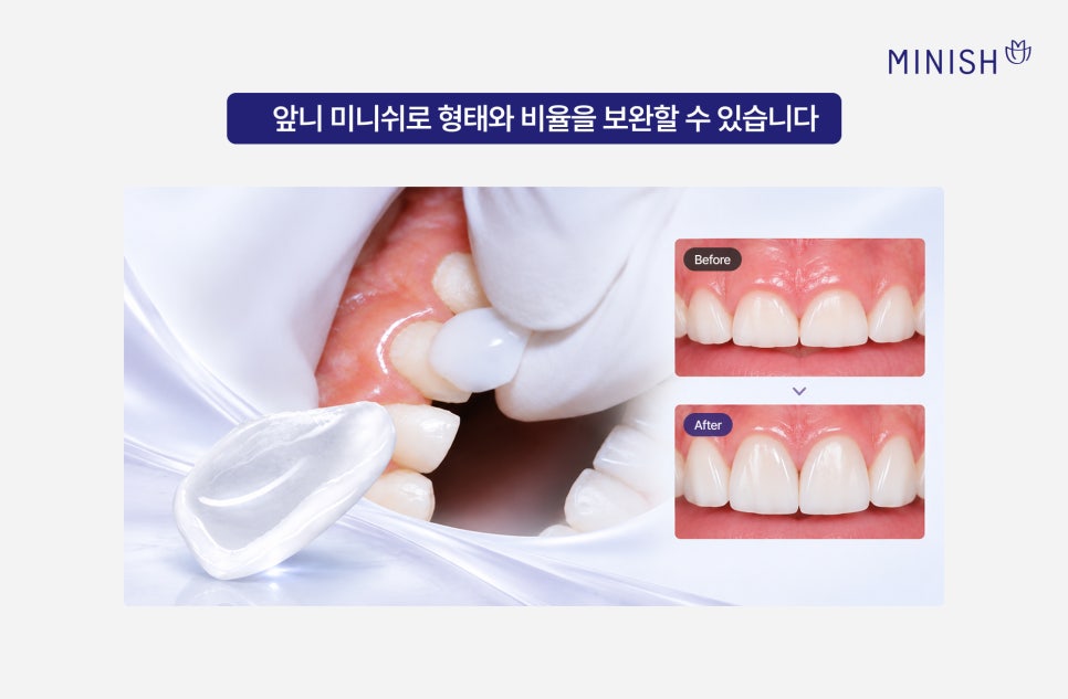 앞니가 짧아 보인다면? 짧은치아 원인과 앞니 미니쉬 관련 이미지 5
