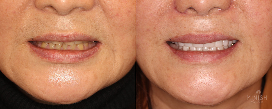Tooth Wear: What Causes It? How to Restore Teeth Healthily image 2