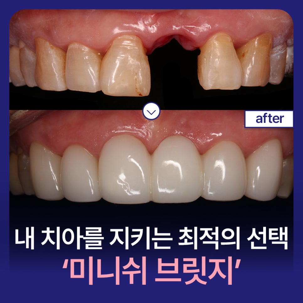 치아 브릿지 vs 미니쉬 브릿지 : 내 치아를 지키는 최적의 선택은? 관련 이미지 1