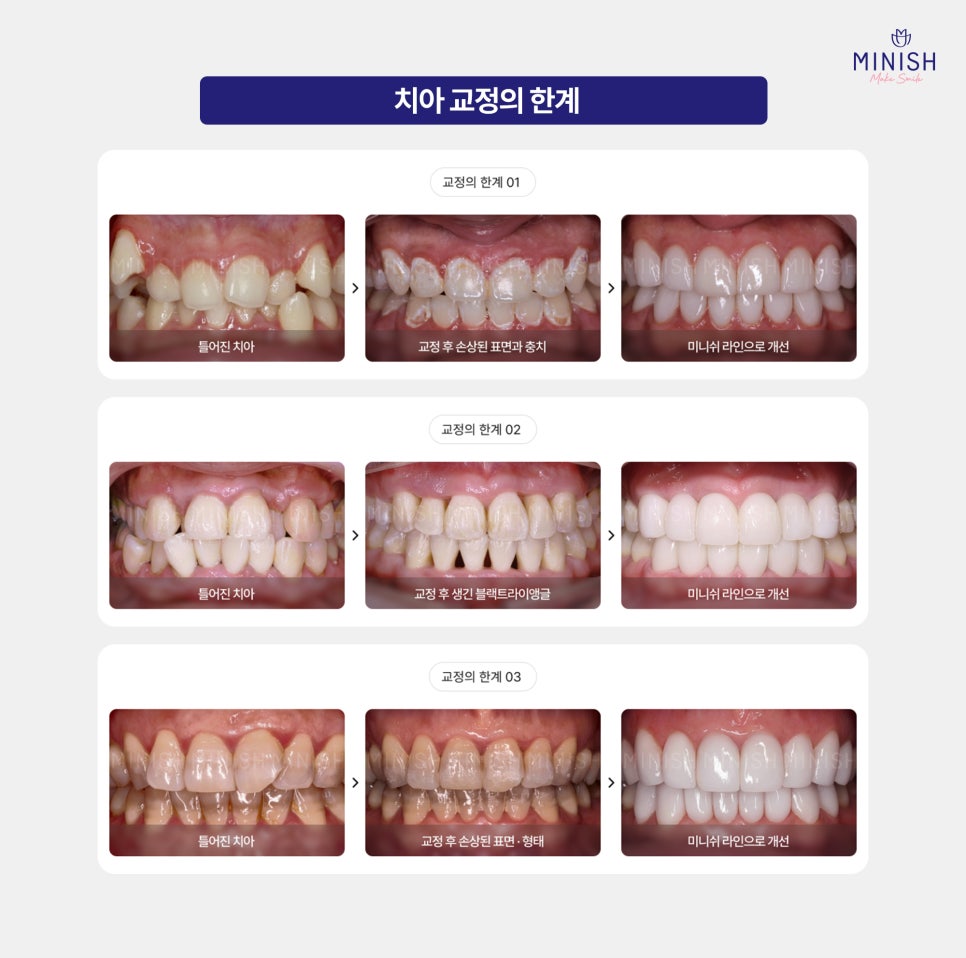 Gaps Between the Front Teeth After Orthodontic Treatment: Addressing Them with the Minish Line image 3