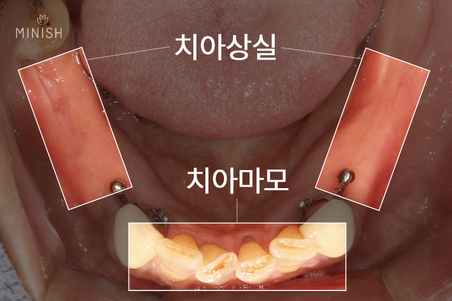 치아실금 방치하면 큰일! 치아코팅으로 건강 되찾으세요 [엄마는예뻤다치과] 관련 이미지 5