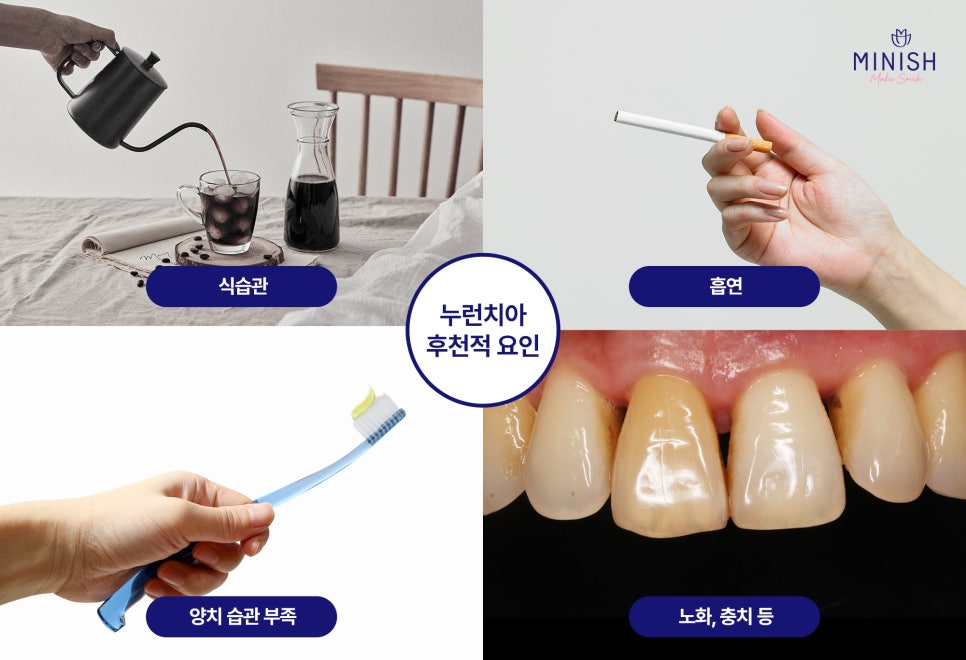 Yellow Teeth, From Causes to Solutions! Which Method Is Right for Me? image 3