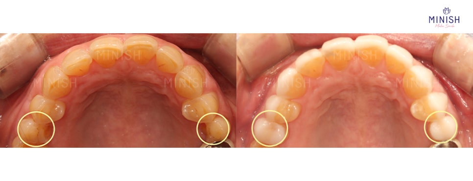 Tooth Wear: What Causes It? How to Restore Teeth Healthily image 6