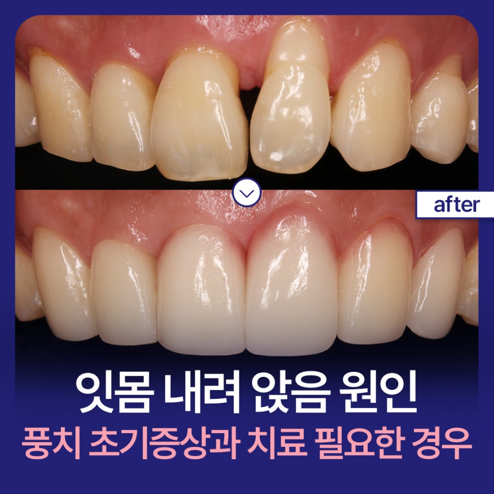 Causes of Receding Gums, Early Signs of Gum Disease, and When Gum Disease Treatment Is Needed image 1