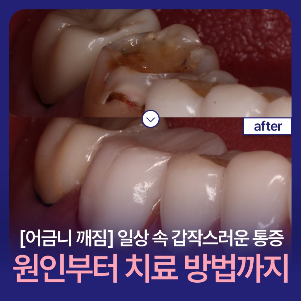 [Cracked Molar] Sudden Pain in Everyday Life, from Causes to Treatment Methods image 1