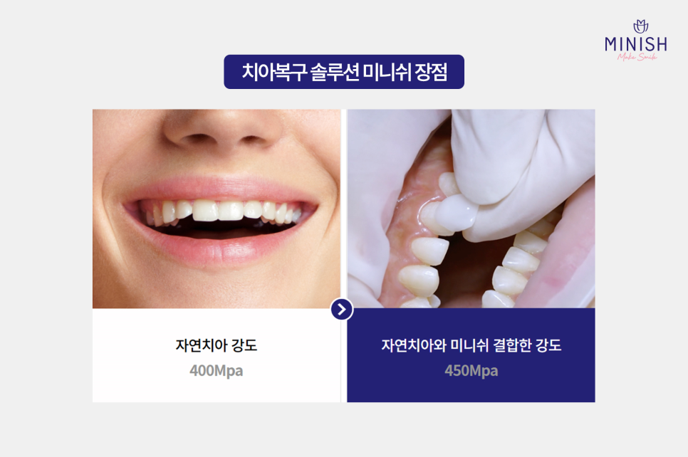 Cracked Teeth, from Cause to Treatment! How to Regain Healthy Teeth image 8