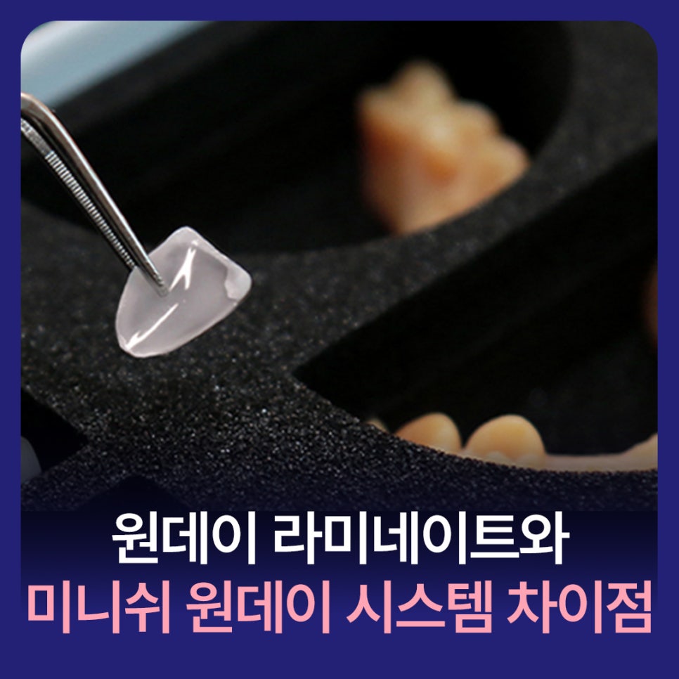원데이라미네이트와 미니쉬 원데이 시스템 왜 다르고, 무엇이 나을까? 관련 이미지 1