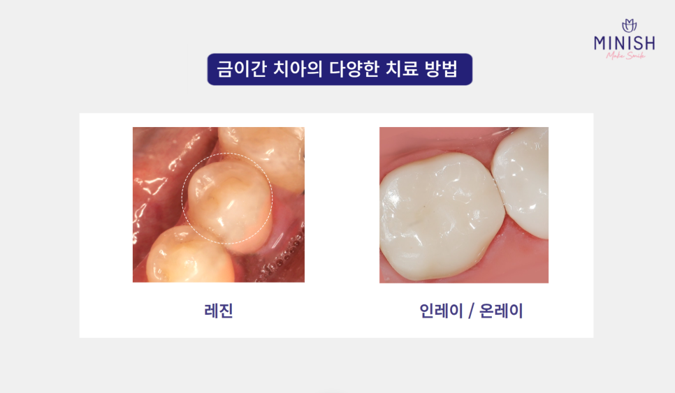 Cracked Teeth, from Cause to Treatment! How to Regain Healthy Teeth image 5