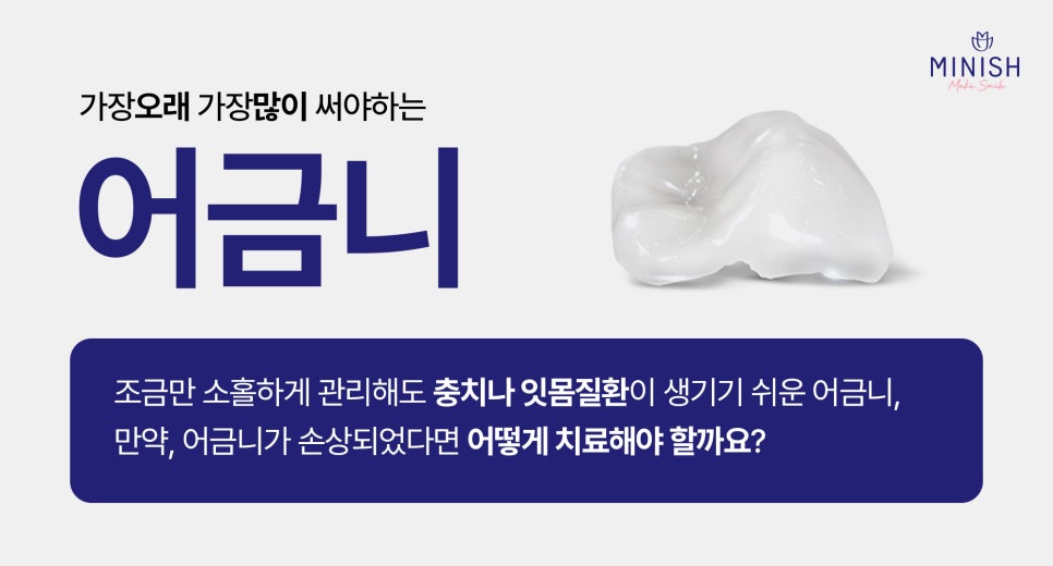 Caused by Cavities? A Complete Guide to Why Molars Break and How to Treat Them image 2