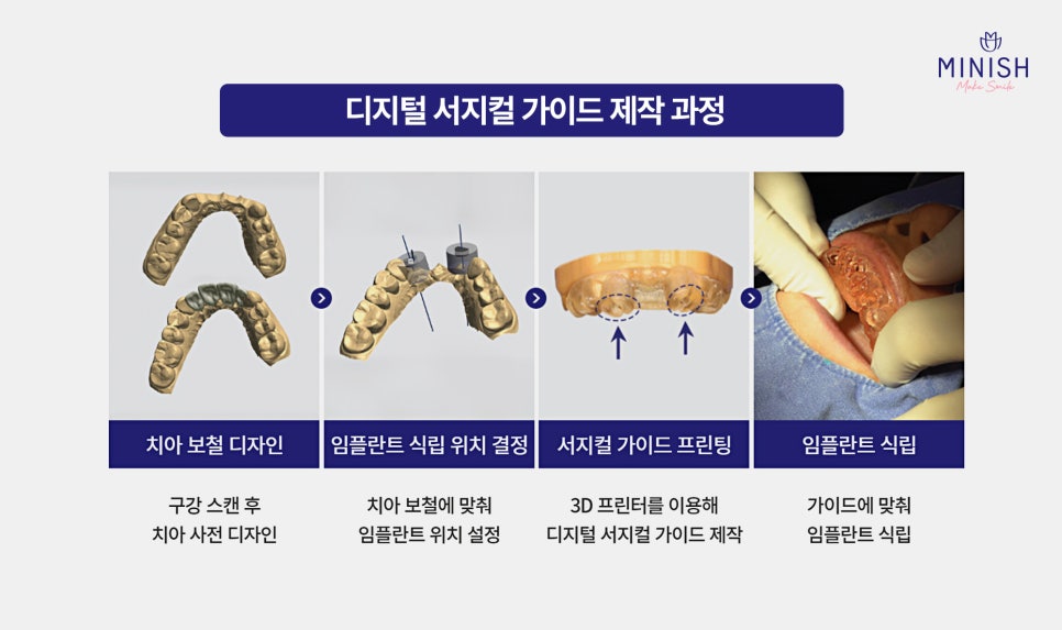 65세이상 임플란트 보험 적용 나이 기준과 주의사항 알아보기 관련 이미지 6