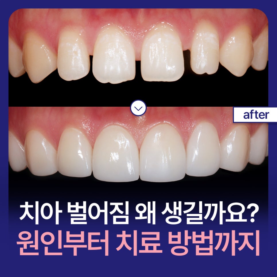 치아 벌어짐 왜 생길까요? 원인부터 치료 방법까지 관련 이미지 1