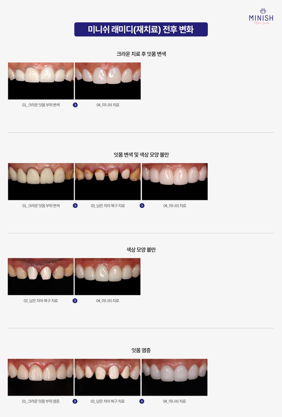 A Complete Guide to the Minish Program That Fits My Teeth image 7