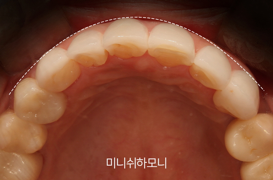 Is It Possible to Straighten Teeth in Just One Day? image 15