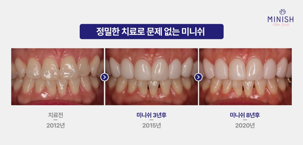미니쉬와 라미네이트 차이점 총정리 관련 이미지 6