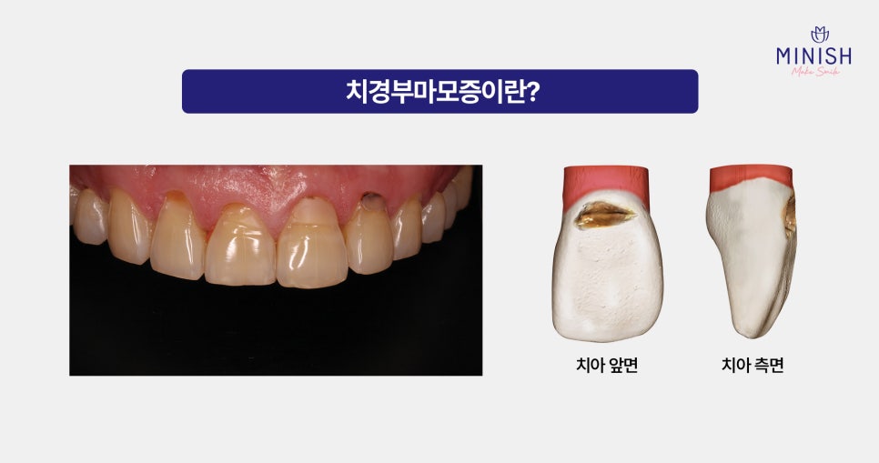 Cervical Abrasion, Causes of Exposed Tooth Roots, and Treatment for Gum Indentations image 2