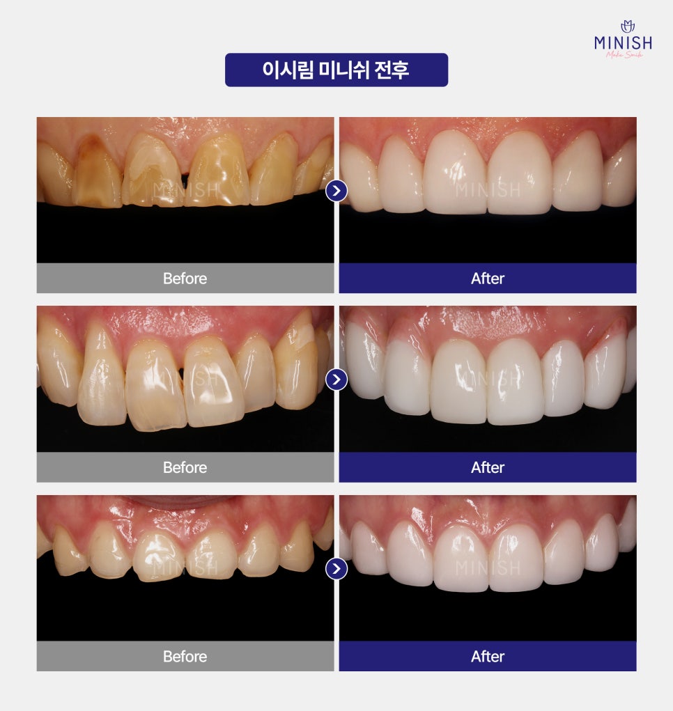 Cold Water Alone Makes Your Teeth Sensitive? A Complete Guide to Causes and Treatment! image 5