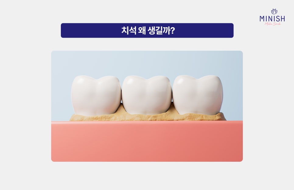 논현동치과 스케일링 주기 얼마나 될까? 스케일링 보험 적용 기준까지 관련 이미지 2