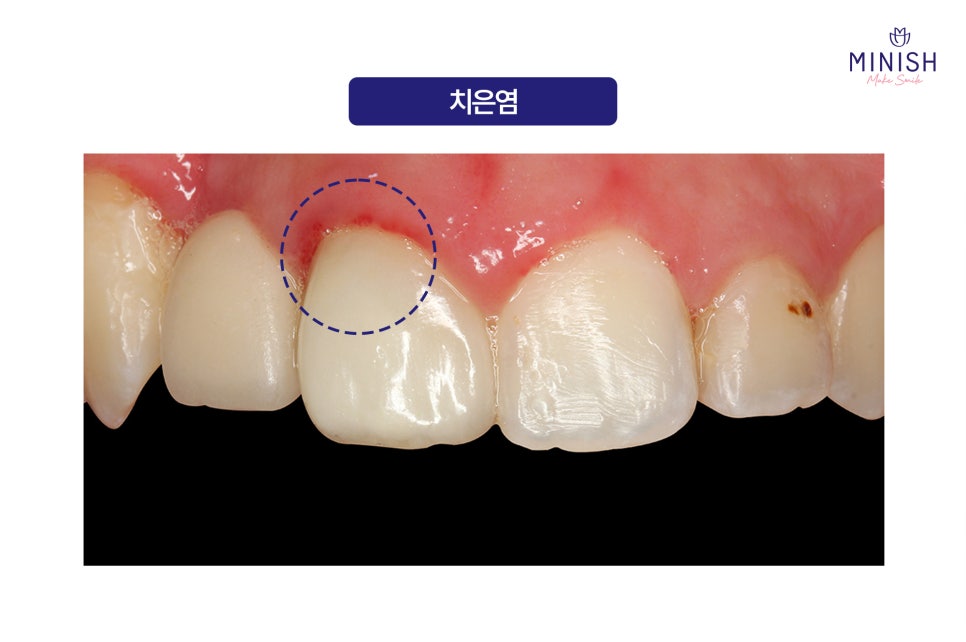 Swollen Gums and Bleeding? Warning Signs of Periodontal Disease image 4