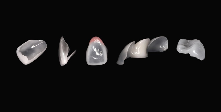 What’s the Difference Between Cosmetic Veneers and Treatment-Oriented Minishe? image 6