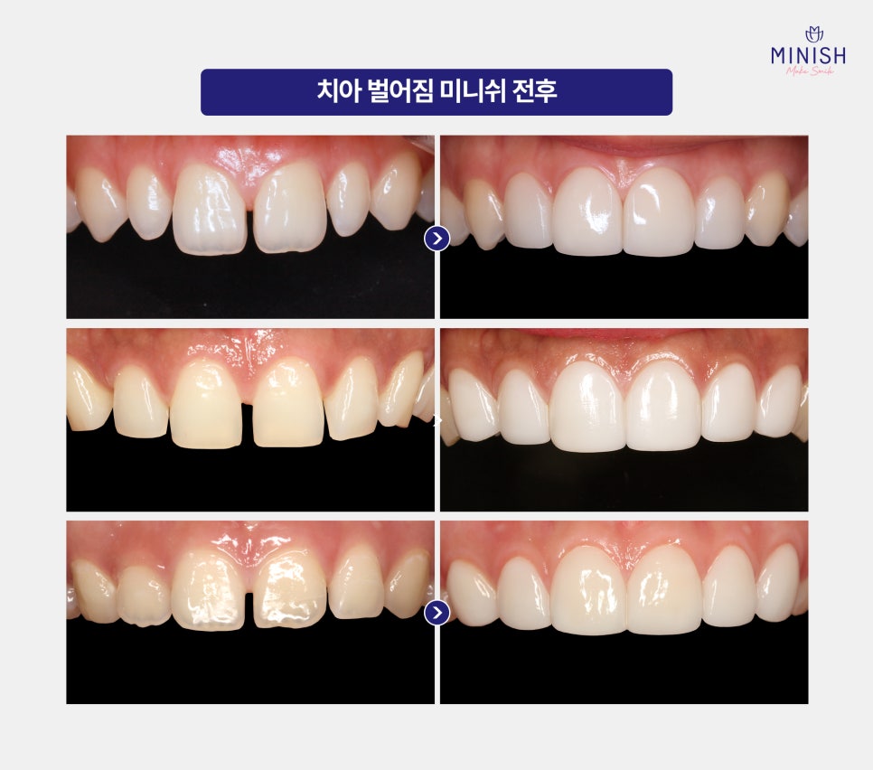 치아 벌어짐 왜 생길까요? 원인부터 치료 방법까지 관련 이미지 5