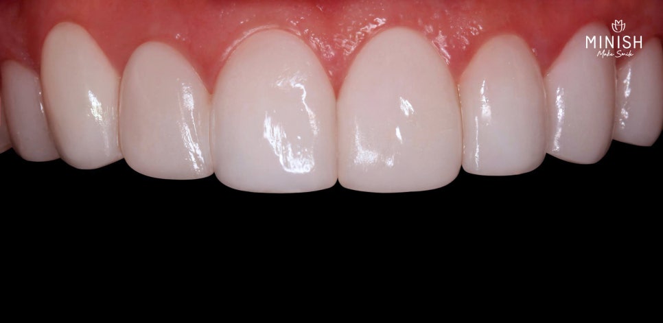 Is It Possible to Straighten Teeth in Just One Day? image 4