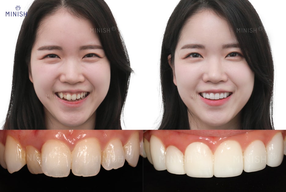 뻐드렁니, 덧니! 치아틀어짐 하루만에 해결하는 미니쉬가격은? 관련 이미지 2