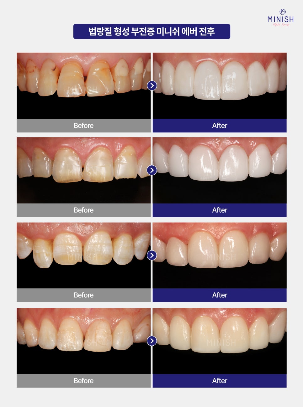 [Amelogenesis Imperfecta] If Your Teeth Wear Down and Break Easily, What Are the Treatment Options? Complete Guide image 5