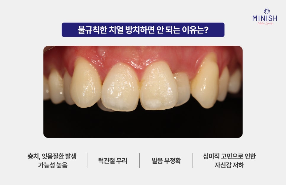 If You Want to Improve Irregular Teeth in Just One Day Without Orthodontics image 2