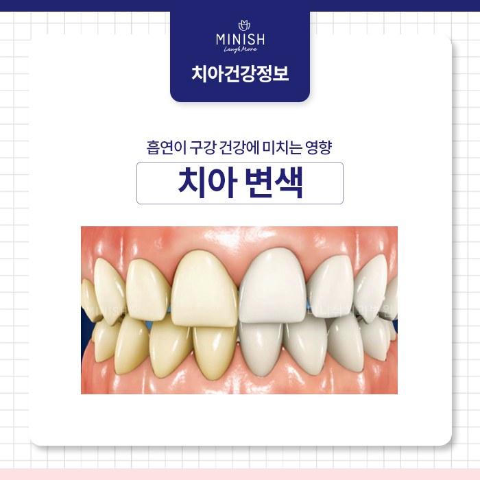 전자담배 흡연, 치아엔 어떨까? 관련 이미지 3