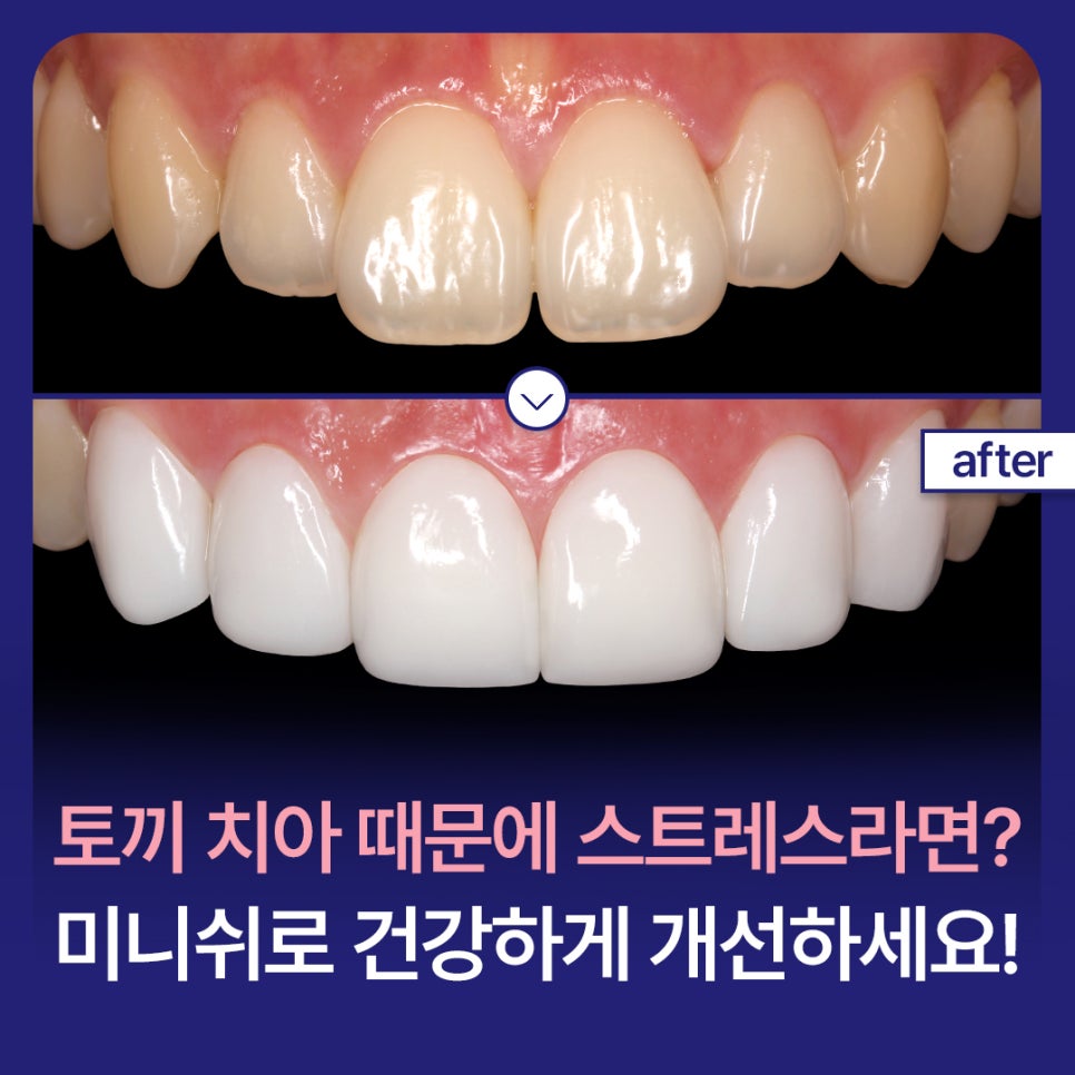 If Rabbit Teeth Are Stressing You Out, Improve Them Healthily with Minishe! image 1