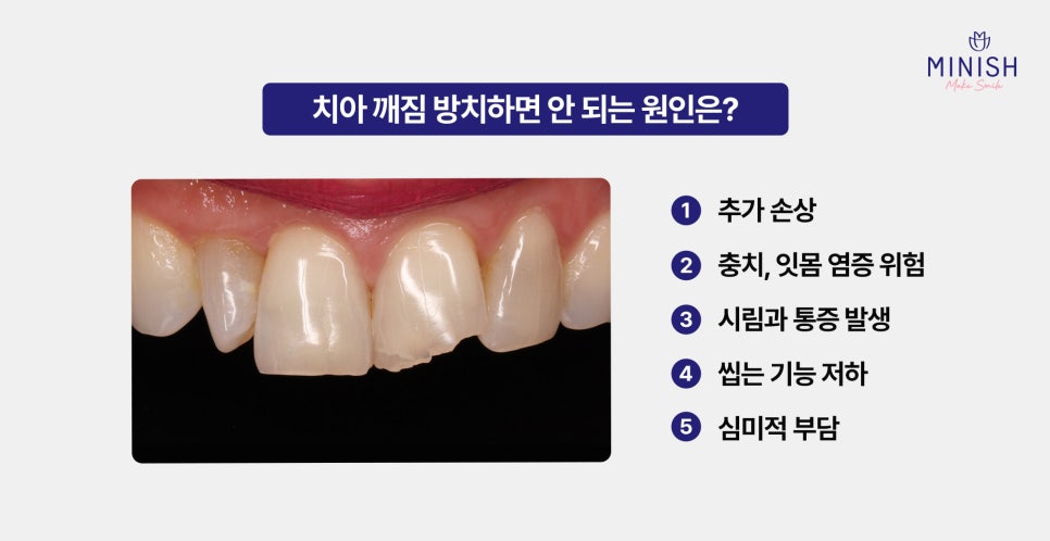 A chipped tooth: the fact that there is a way to restore it like a natural tooth! image 2