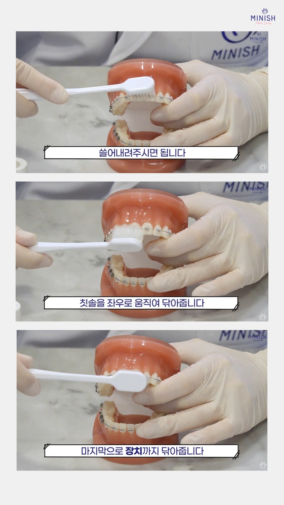 치아교정 양치질이 중요한 이유와 올바른 방법까지 알려드려요 관련 이미지 5