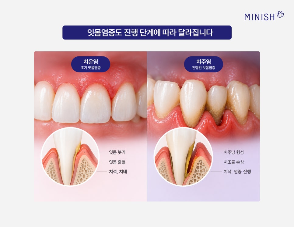 잇몸염증, 잇몸 부었을 때 필요한 치료는? 관련 이미지 4