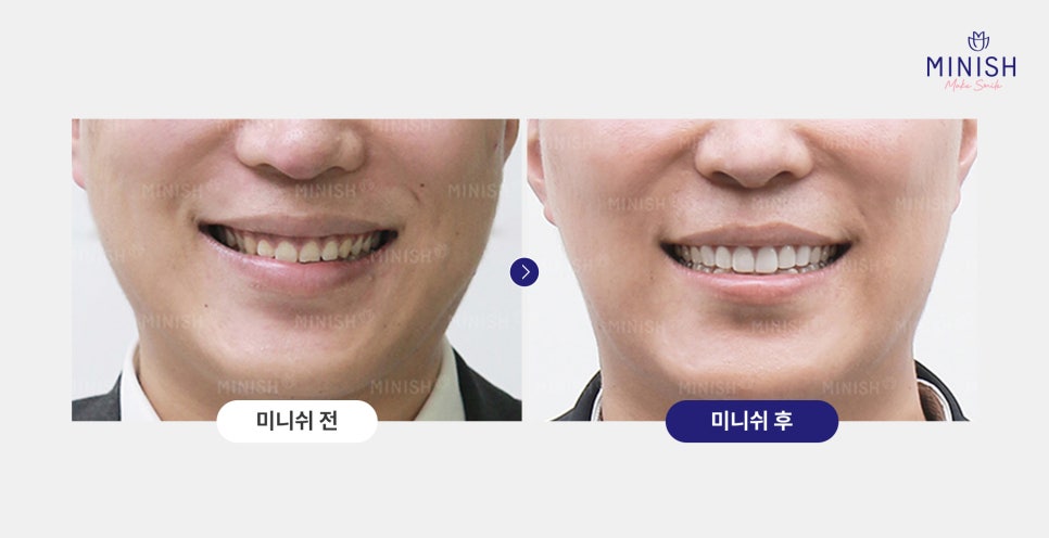 웃을 때 잇몸 과다 노출, 거미스마일 잇몸성형 알아보신다면? 관련 이미지 6