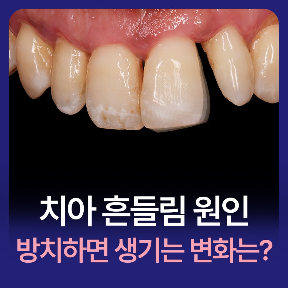 강남구청역치과 치아 흔들림 원인, 방치하면 생기는 변화 관련 이미지 1