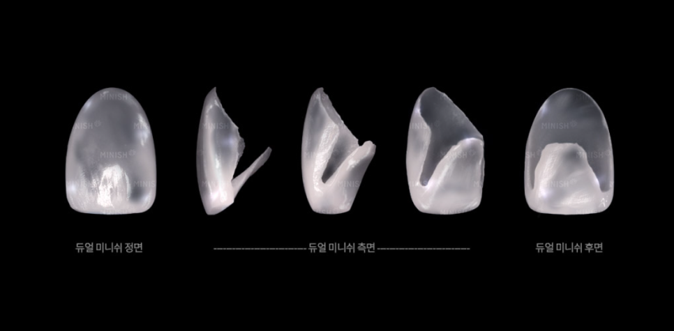 Why Choose Minish Instead of Crowns for Tooth Erosion After Overcoming Cancer? image 9