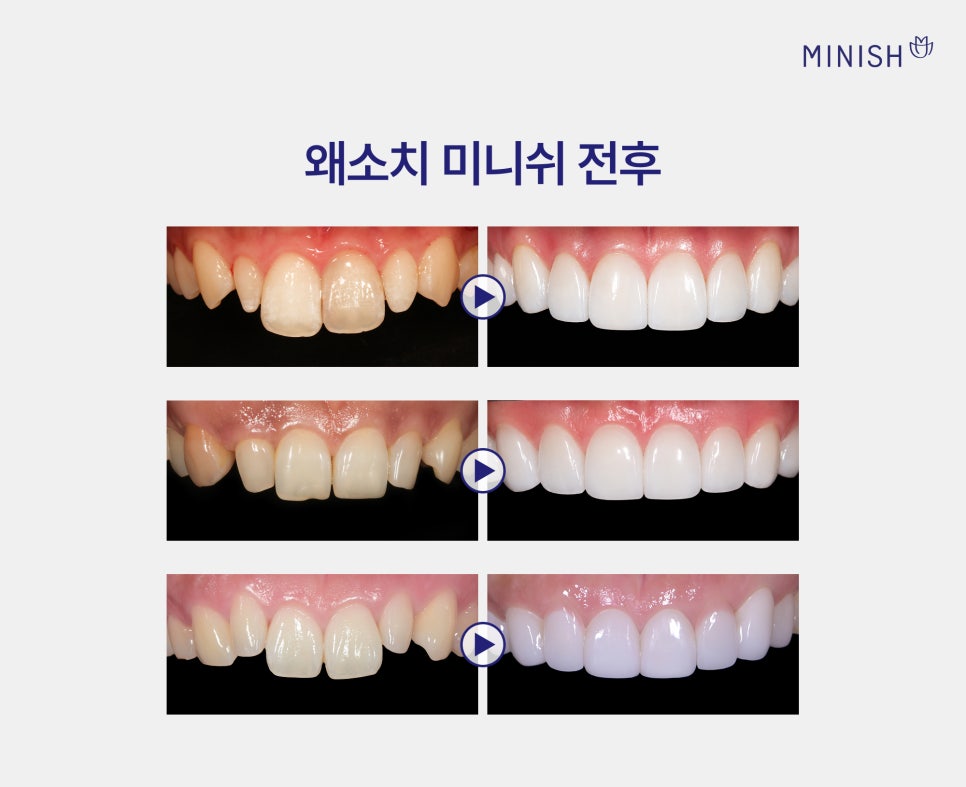 왜소치 교정만으로 작은치아 고민이 해결되지 않을 땐? 미니쉬 심플 관련 이미지 6