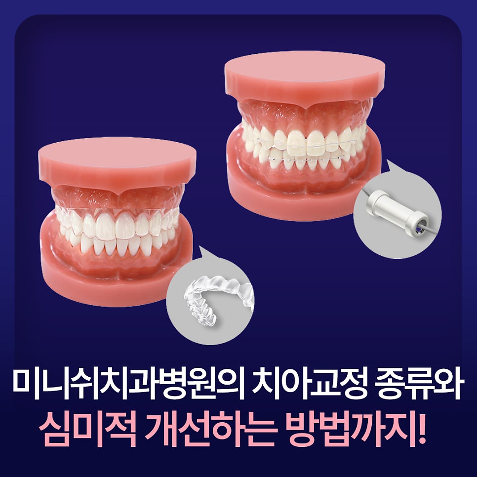 Types of Orthodontic Treatment at Minish Dental Hospital and How to Improve Aesthetics Too! image 1