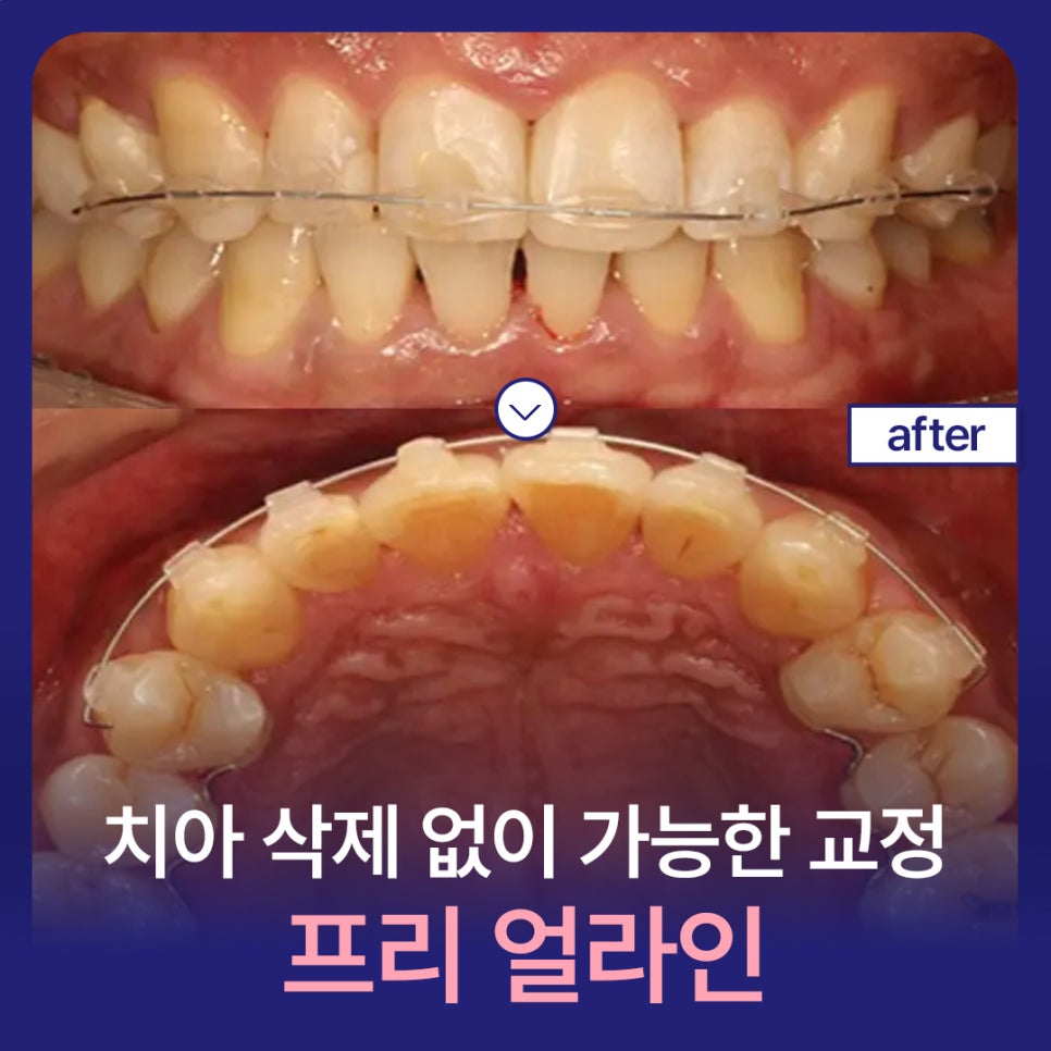 Orthodontics Without Tooth Reduction! Pre Align image 1