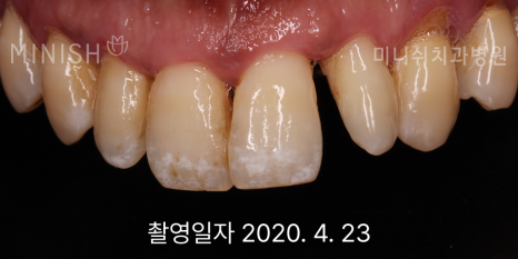 잇몸 내려앉음, 잇몸퇴축 원인과 치료 방법은? 관련 이미지 7