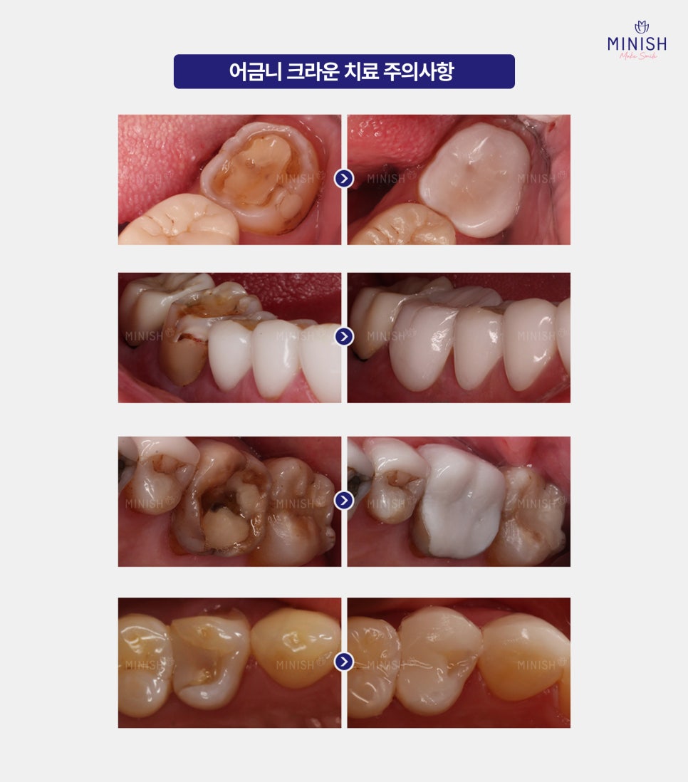 The Difference Between Molar Crowns and Minish from the Perspective of Preserving Teeth image 5