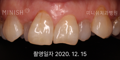 잇몸 내려앉음, 잇몸퇴축 원인과 치료 방법은? 관련 이미지 5