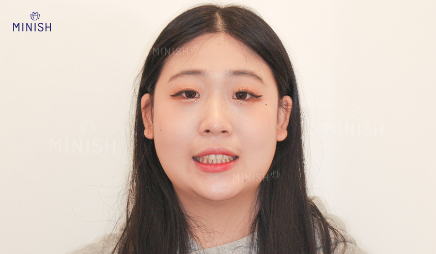 안성엄마와 딸을 괴롭힌 잇몸병 [엄마는예뻤다] 관련 이미지 12