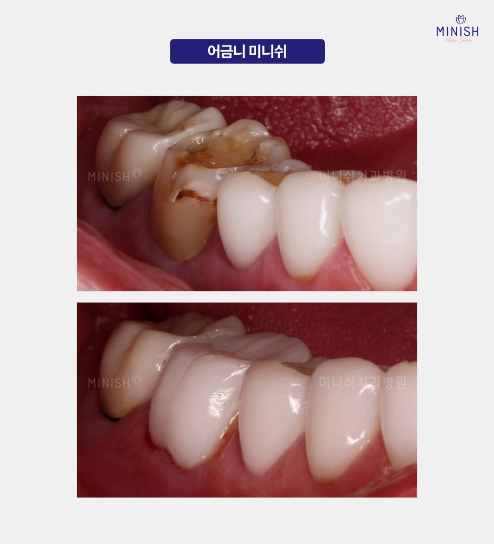 What Is the Best Way to Treat Cavities? What Is a Healthy Way to Protect My Teeth? image 4