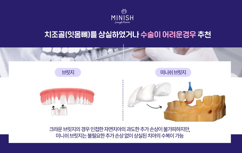 치아로 잘 씹지 못하면 치매 위험이 높아진다?! 관련 이미지 5
